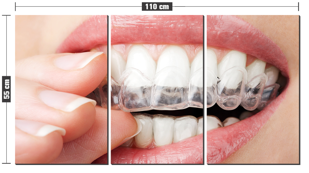 Clareamento dental